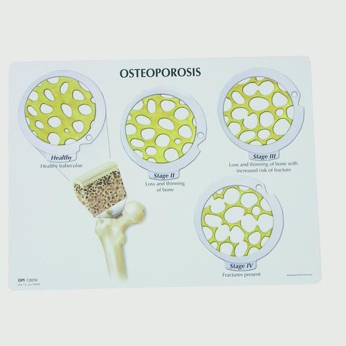 Set di dischi con tumore alle ossa - 4 stadi dell'osteoporosi, 1019509, Modelli di vertebre