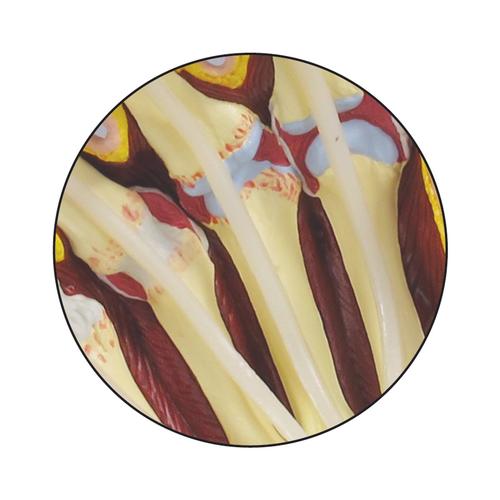 Modello di mano con artrite reumatoide, 1019521, Modelli di scheletro della mano e del braccio