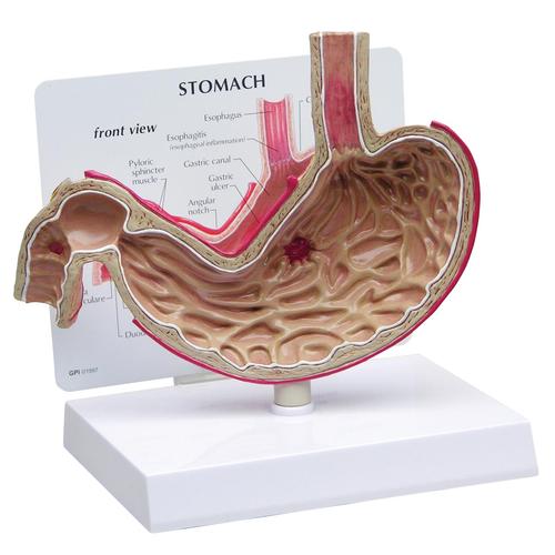 Modello di stomaco con ulcere, 1019523, Modelli di Sistema Digerente