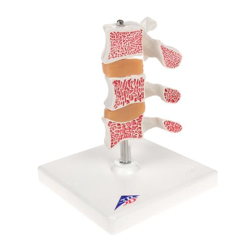 Osteoporosi, modello di lusso - 3B Smart Anatomy, 1000153 [A78], Strumenti didattici su artrite e osteoporosi