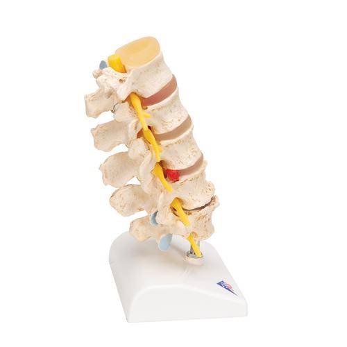 Stadi dell’ernia del disco intervertebrale e degenerazione della vertebra - 3B Smart Anatomy, 1000158 [A795], Modelli di vertebre
