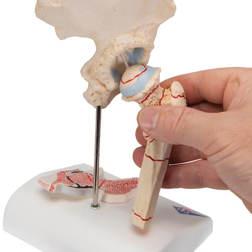 Frattura del femore e lussazione dell’anca - 3B Smart Anatomy, 1000175 [A88], Modelli delle Articolazioni