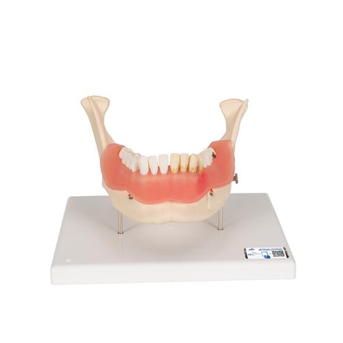 Patologie dentali, ingrandito 2 volte, 21 pezzi - 3B Smart Anatomy, 1000016 [D26], Modelli Dentali