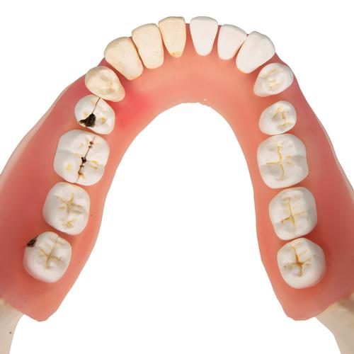 Patologie dentali, ingrandito 2 volte, 21 pezzi - 3B Smart Anatomy, 1000016 [D26], Modelli Dentali