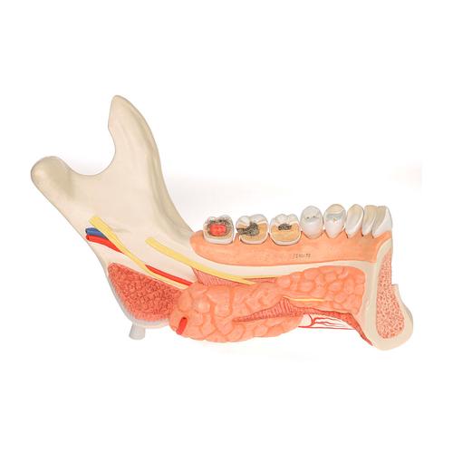 Metà mandibola con 8 denti cariati, in 19 parti - 3B Smart Anatomy, 1001250 [VE290], Modelli Dentali