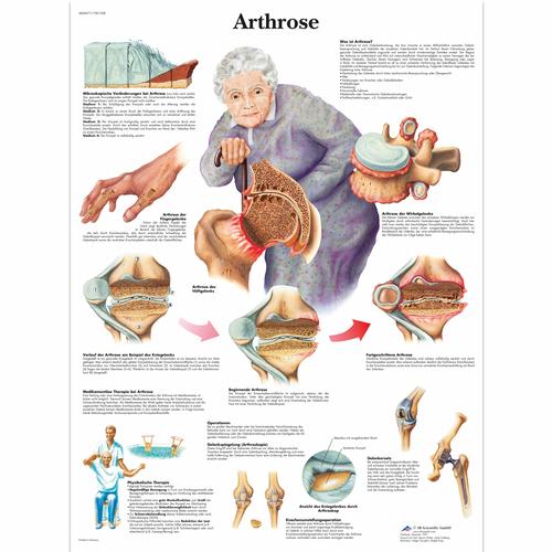Arthrose, 1001308 [VR0123L], Strumenti didattici su artrite e osteoporosi