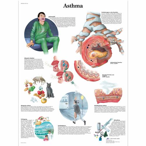 Asthma, 1001354 [VR0328L], Strumenti didattici su asma e allergie