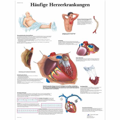 Häufige Herzerkrankungen, 1001362 [VR0343L], Strumenti didattici cardiaci e di cardiofitness