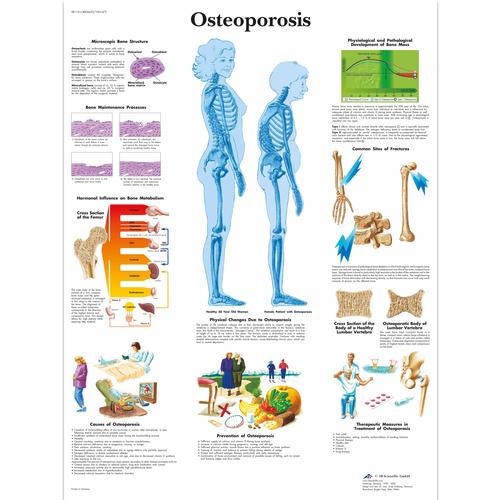 Osteoporosis, 4006653 [VR1121UU], Sistema Scheletrico