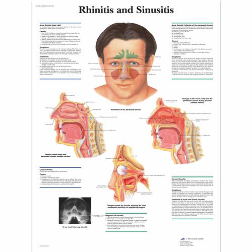 Rhinitis and Sinusitis Chart, 1001504 [VR1251L], Naso, Orecchie e Gola