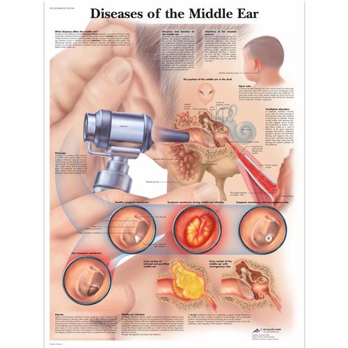 Diseases of the Middle Ear, 4006670 [VR1252UU], Naso, Orecchie e Gola