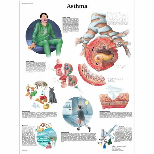 Asthma, 4006677 [VR1328UU], Strumenti didattici su asma e allergie