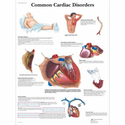 Common Cardiac Disorders Chart, 1001526 [VR1343L], sistema Cardiovascolare