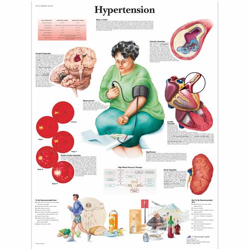 Hypertension Chart, 1001532 [VR1361L], sistema Cardiovascolare