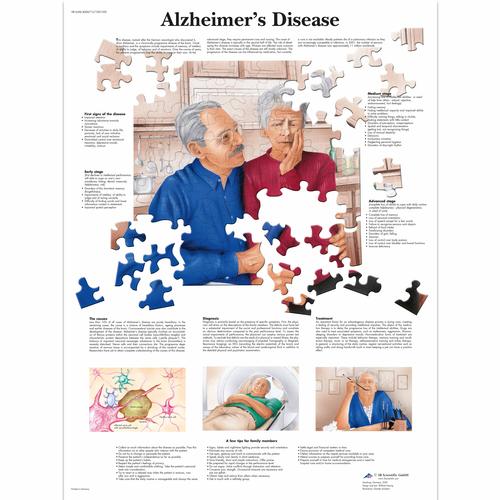 Alzheimer's Disease, 4006713 [VR1628UU], Cervello e del sistema nervoso