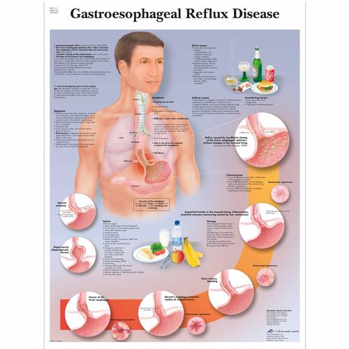 Gastroesophageal reflux disease, 1001602 [VR1711L], Il sistema digestivo
