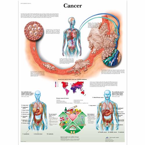Cancer, 1001612 [VR1753L], Cancro
