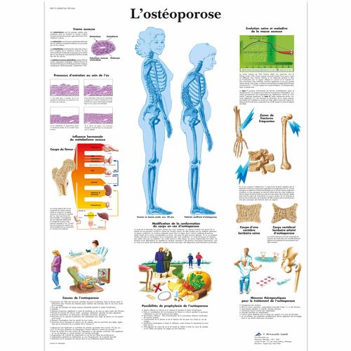 L'ostéoporose, 1001634 [VR2121L], Strumenti didattici su artrite e osteoporosi