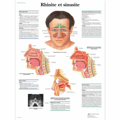 Rhinite et sinusite, 1001670 [VR2251L], Naso, Orecchie e Gola
