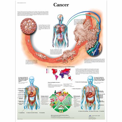 Cancer, 4006805 [VR2753UU], Cancro

