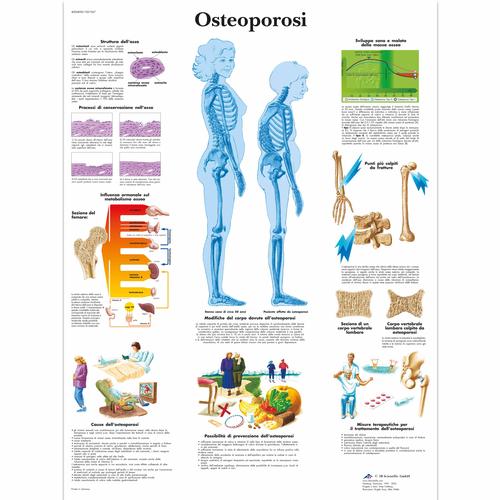 Osteoporosi, 1001967 [VR4121L], Strumenti didattici su artrite e osteoporosi