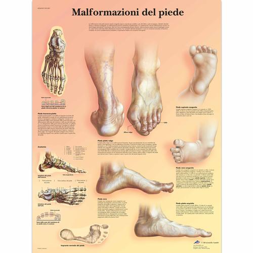 Malformazioni di piede, 4006909 [VR4185UU], Sistema Scheletrico