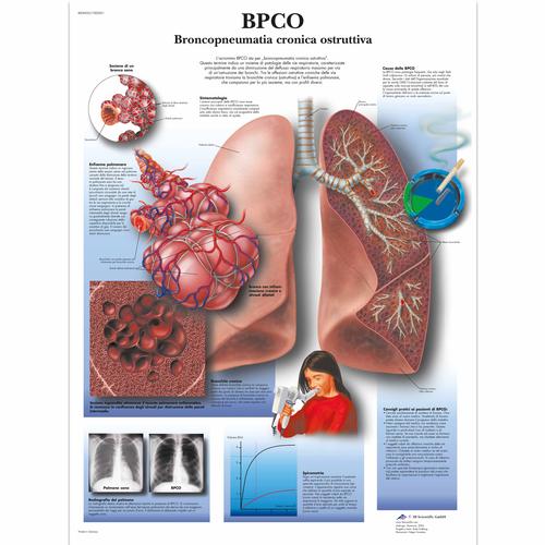 BPCO Broncopneumopatia cronia ostruttiva, 1002021 [VR4329L], Strumenti didattici sul fumo