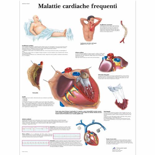 Malattie cardiache frequenti, 4006928 [VR4343UU], sistema Cardiovascolare