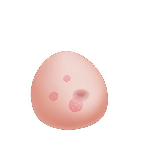 Modello di mammella per ultrasuoni con tumori SONOtrain – Mammella di ricambio, 1019650 [XP125], Consumables