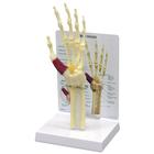 Modello di mano/polso con sindrome del tunnel carpale, 1019519, Modelli di scheletro della mano e del braccio