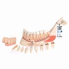 Metà mandibola con 8 denti cariati, in 19 parti - 3B Smart Anatomy, 1001250 [VE290], Modelli Dentali