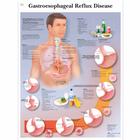  Gastroesophageal reflux disease, 1001602 [VR1711L], Il sistema digestivo
