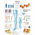 Varices, varicosités, 4006767 [VR2367UU], sistema Cardiovascolare