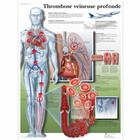 Thrombose veineuse profonde, 1001703 [VR2368L], sistema Cardiovascolare
