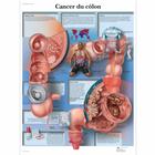   Cancer du côlon, 1001717 [VR2432L], Cancro
