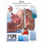 EPOC Enfermedad pulmonar obstructiva crónica, 4006840 [VR3329UU], Strumenti didattici sul fumo