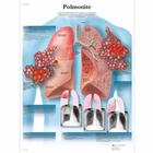 Polmonite, 1002017 [VR4326L], Parassitarie, virali e da infezione batterica