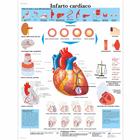 Infarto cardiaco, 4006927 [VR4342UU], sistema Cardiovascolare