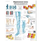 Медицинский плакат "Варикозные вены", 1002276 [VR6367L], Sistema circolatorio